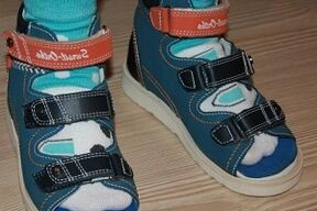 Indossare sandali per l'alluce valgo in un bambino