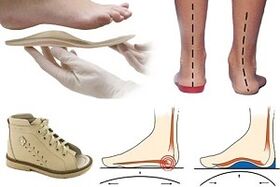 Scarpe ortopediche per alluce valgo in un bambino