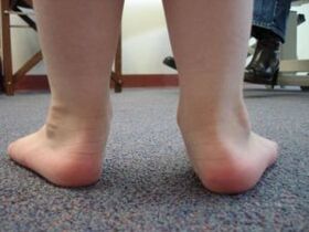 Deformità del piede valgo piatto in un bambino