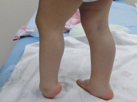 I primi sintomi della deformazione del valgo del piede