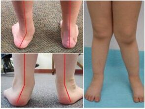 Valgus